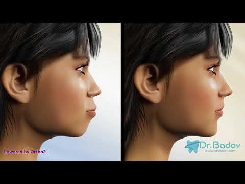 Видео: #ортодонт #брекети #вадененазъби Брекети и изваждане на зъби. Как брекетите подреждат зъбите?