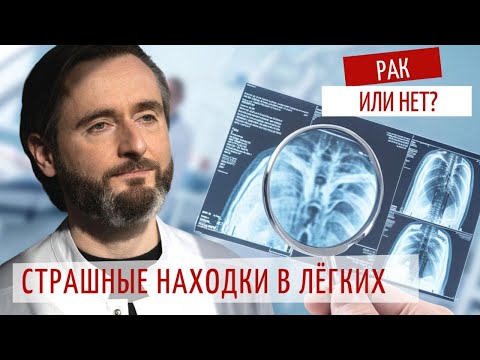 Видео: КТ лёгких: 3 страшных “диагноза”, которые не так опасны, как кажется