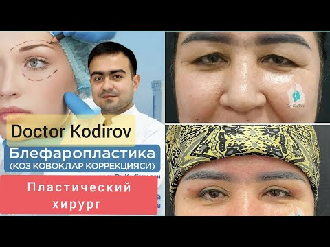 Видео: Пластик жарроҳ Doctor_Kodirov. Блефаропластика
