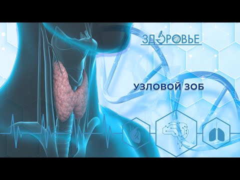 Видео: Узловой зоб | Здоровье 24.06.2023