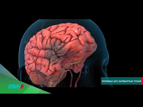 Видео: Тархины цус харвалт Грандмед