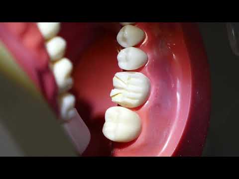 Видео: Полностью циркониевая коронка №30 (с закругленным уступом) — д-р Марк Р. Тейлор