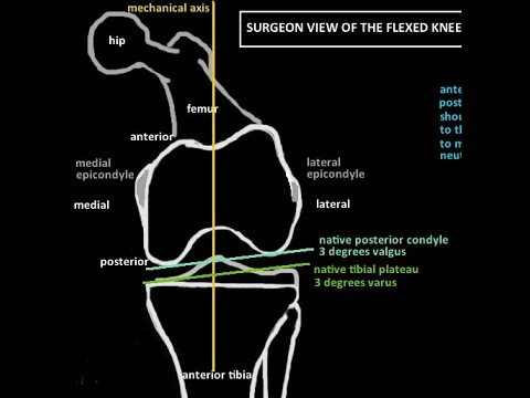 Видео: Теория костных разрезов при тотальном эндопротезировании коленного сустава