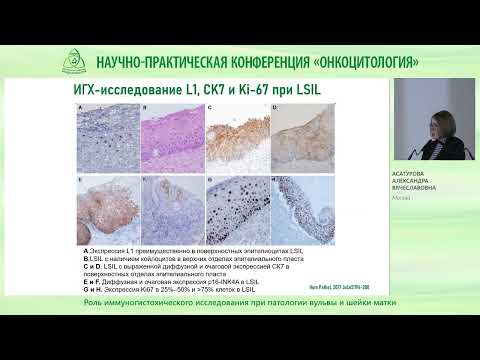 Видео: Роль иммуногистохического исследования при патологии вульвы и шейки матки