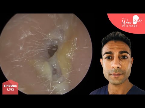 Видео: 1,312 - Очень сложное удаление глубоко залегающих обломков