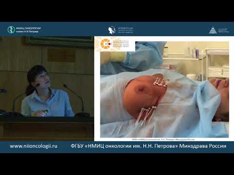 Видео: Радиотерапия раннего и местно-распространенного рака молочной железы
