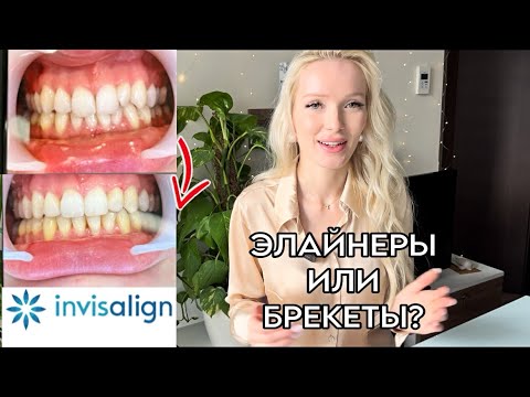 Видео: Invisalign отзыв об элайнерах: цена, сколько носить