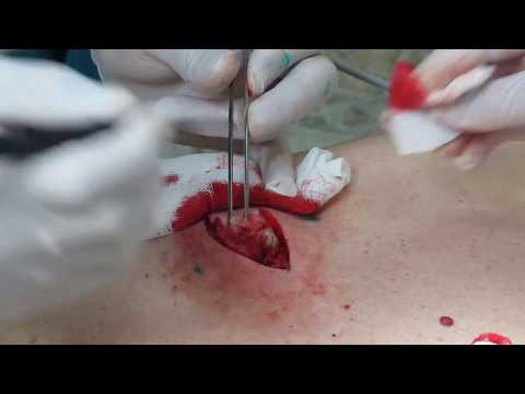 Видео: Удаление крупного жировика (атеромы) на спине с примерением радиоволны.
