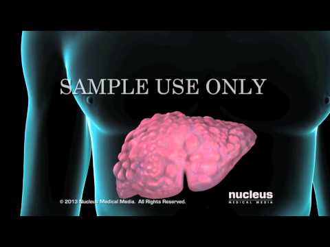 Видео: Гепатит С