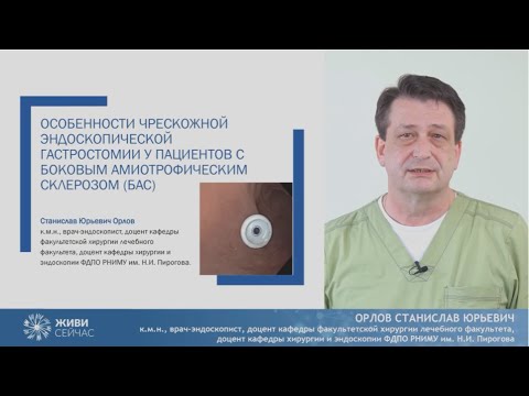 Видео: Чрескожная эндоскопическая гастростомия для пациентов с БАС: взгляд эндоскописта