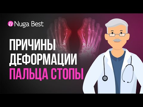 Видео: ПОЧЕМУ появляются КОСТОЧКИ НА НОГАХ? | Доктор Здоровье о том, как предотвратить проблему