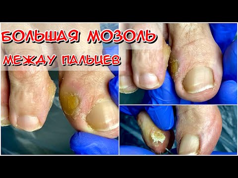 Видео: Большая мозоль между пальцев / Целующиеся мозоли / мозоль от обуви