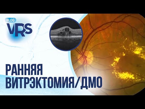 Видео: Сахарный диабет / Диабетическая ретинопатия / Ранняя витрэктомия / ДМО