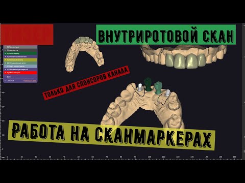 Видео: exocad. Моделирование резцов на имплантатах, интрооральный скан. Сканмаркера. Цирконий.