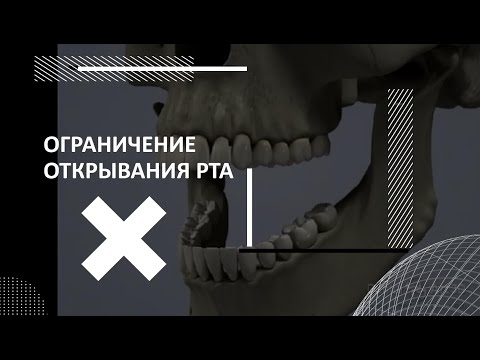 Видео: ОГРАНИЧЕНИЕ ДИНАМИКИ ЧЕЛЮСТИ