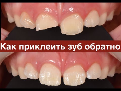 Видео: Фиксация фрагмента при неосложненном переломе коронки постоянного зуба
