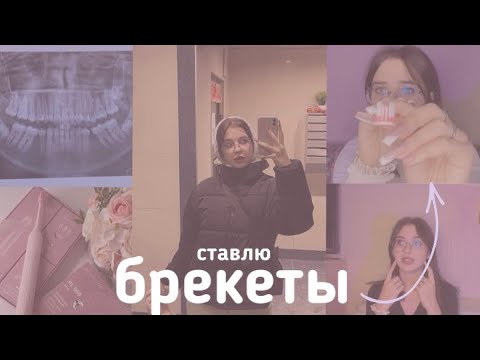 Видео: ставлю брекеты! 😬😱 | как я лечу зубы? что с ними не так?! || Polinest💕