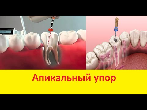 Видео: Эндодонтия для начинающих - техника степ бэк, формирование апикального упора - лечение каналов
