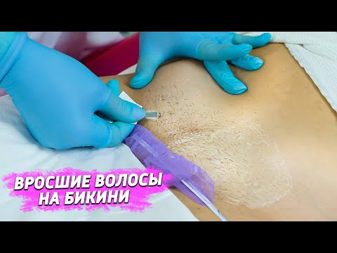 Видео: Вросшие волосы в зоне БИКИНИ - Как избавиться?