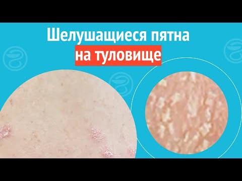 Видео: 😦 Шелушащиеся пятна на туловище. Клинический случай №1664