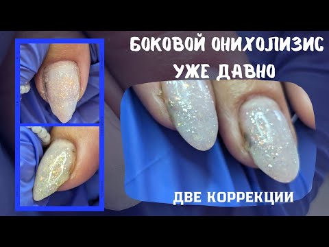 Видео: ДВЕ КОРРЕКЦИИ // ОНИХОЛИЗИС - НИЧЕГО НЕ ПОМОГЛО