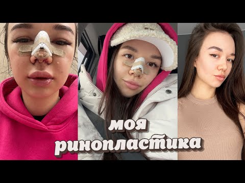 Видео: Моя РИНОПЛАСТИКА в Москве, без синяков?🙀