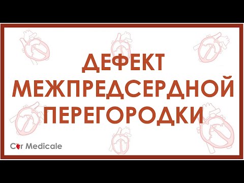 Видео: Дефект межпредсердной перегородки: что такое, механизм развития, симптомы и осложнения - кратко