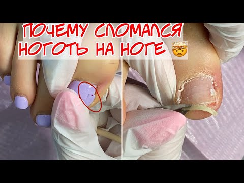 Видео: Сломанный ноготь на ноге 😫 Ремонт сломанного ногтя? 🤬 Разберем почему появилась трещина на ногте