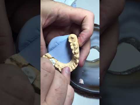 Видео: Нанесение керамики emax. Пресс Керамика с нанесением. Изготовление керамической коронки.