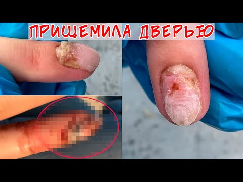 Видео: Прищемила палец дверью - ноготь вырван с корнем / 3 месяца в гипсе
