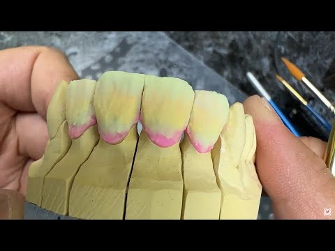 Видео: Фронт: Нанесение керамики (простое нанесение)