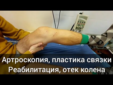 Видео: Реабилитация колена после артроскопии, пластики крестообразной. Отек коленного сустава. УЗИ сустава