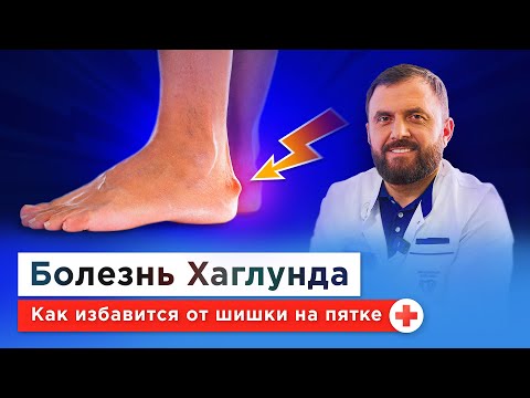 Видео: О чем говорит боль в пятке? Деформация Хаглунда-Шинца: причины, симптомы, бесплатное лечение по ОМС