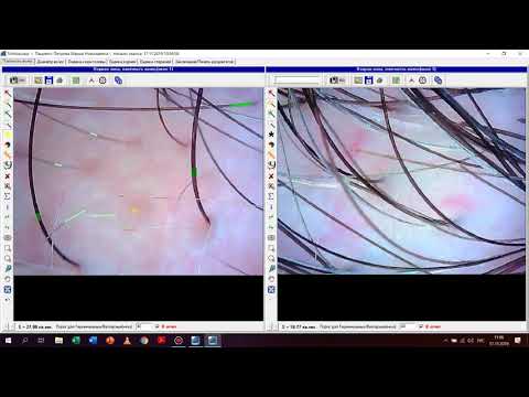 Видео: Трихоскопия в программе TrichoScience c новым модулем для ASW