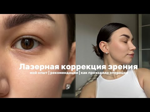 Видео: Лазерной коррекции зрения | мой опыт | больно ли было | рассказываю весь процесс