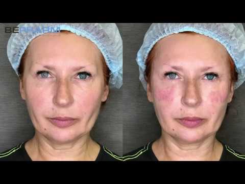Видео: Мастер-класс применения филлеров и нитей в одной процедуре