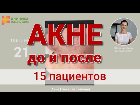 Видео: АКНЕ - До и после - 15 пациентов. Полное видео