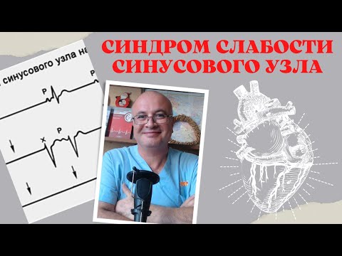 Видео: Синдром слабости синусового узла (СССУ). Дисфункция синусового узла