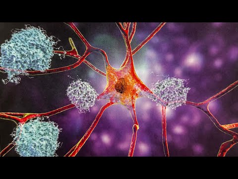 Видео: Хроническая воспалительная демиелинизирующая полинейропатия.