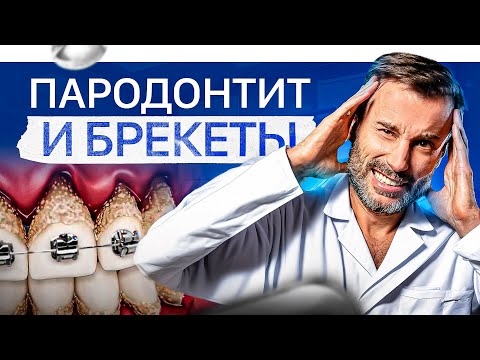 Видео: Брекеты при пародонтите. Все нюансы простыми словами за 13 минут