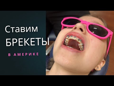 Видео: СТАВИМ РЕБЁНКУ БРЕКЕТЫ В АМЕРИКЕ 