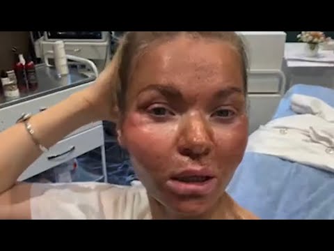 Видео: Лечение офтальморозацеа себе. Эфир 2 февраля 2024