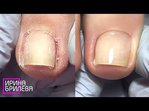 Видео: Педикюр 👣 Пока ещё не вросший ноготь 👣 Особенности тампонирования