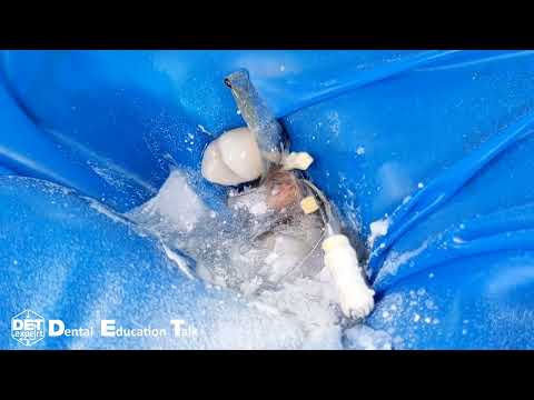 Видео: Преэндодонтический билдап 25 кламп B4, фиксация перфорации K-файлами DET.expert & Sanctuary 4K