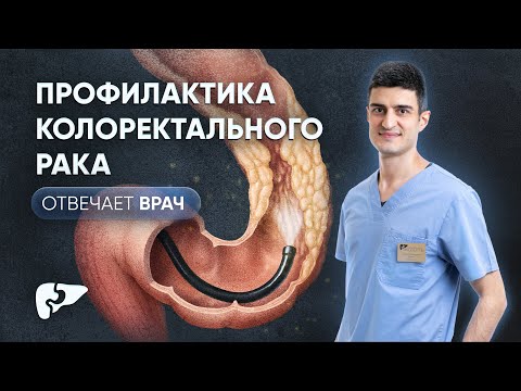 Видео: Колоректальный рак: симптомы, диагностика, группа риска