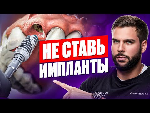 Видео: Кому НЕЛЬЗЯ ставить ИМПЛАНТЫ? 4 мало очевидные причины отказаться от имплантации зубов