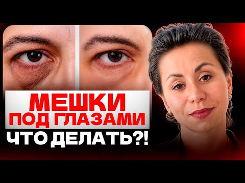 Видео: КАК БЫСТРО ИЗБАВИТЬСЯ от СИНЯКОВ и МЕШКОВ ПОД ГЛАЗАМИ?