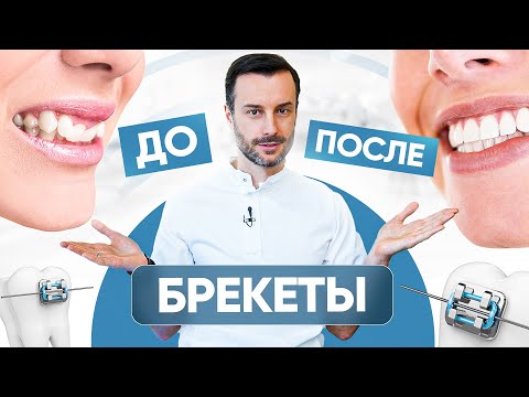 Видео: Брекеты - До и После. Как сильно ровные зубы меняют внешность?