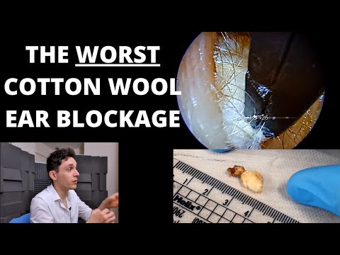Видео: Самая худшая заложенность ушей ватой, которую я когда-либо видел