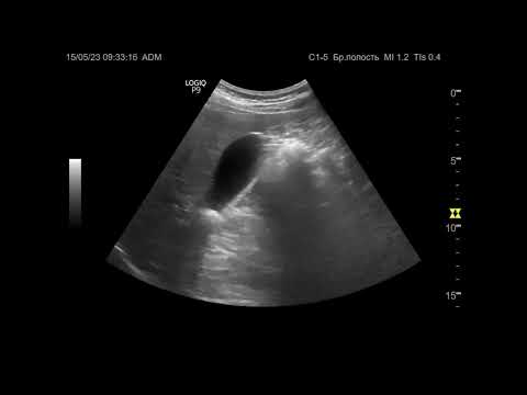 Видео: Ультразвуковая диагностика (УЗИ). Доктор Иогансен. Видеопримеры. Выпуск 16. Камни желчного пузыря.